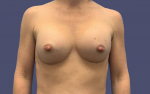 Breast Augmentation 10 After